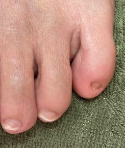 足の爪の役割 足の小指の爪は ありますか 和歌山 メディカルフットケア アン