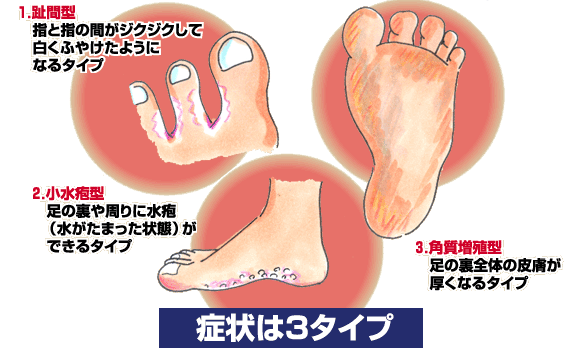 蒸し暑い毎日 足の手入れで水虫を予防しましょう 和歌山 メディカルフットケア アン