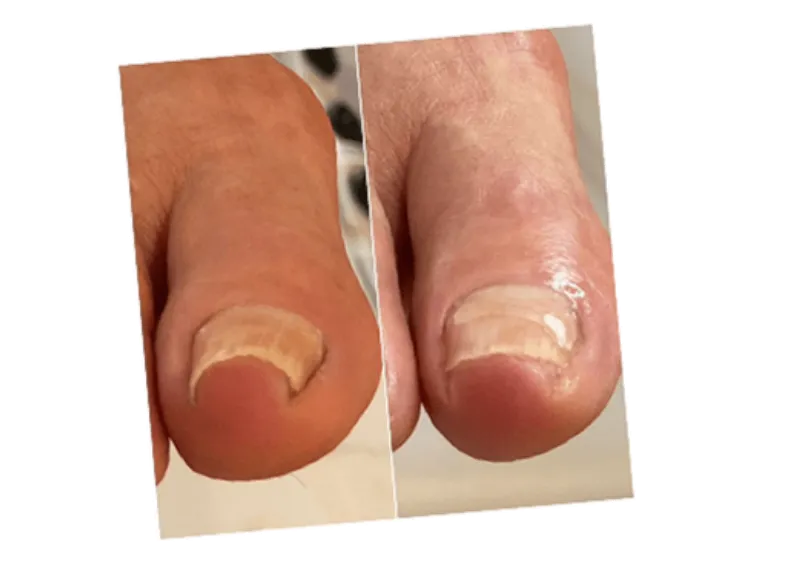 巻き爪の痛みから解放されたお客様の声