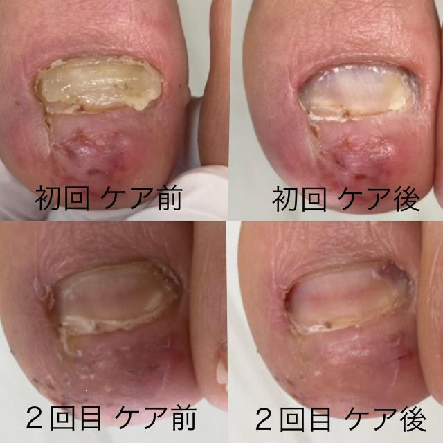 和歌山 メディカルフットケア アン 看護師による安心 安全 安楽なフットケア で安定する足もとづくり 歩くことにストレスを感じている方の足も気持ちも軽くして どこまでも活き活き歩いてゆける身体づくりをお手伝いいたします