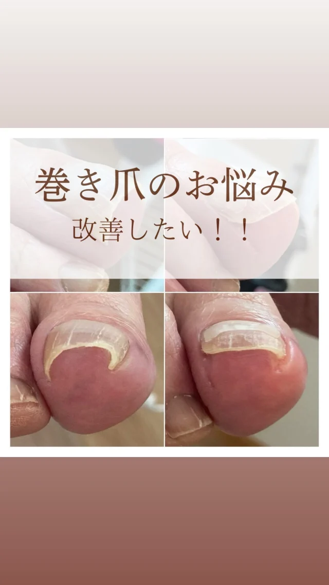 足の小指の爪は小さくなっていませんか？ | 和歌山｜メディカル