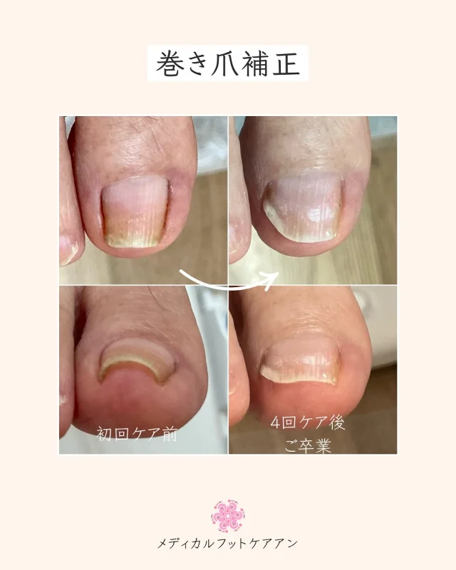 左足の小指の爪 足の爪の悩み】小指の爪がない・・小さい・・その原因と解決策